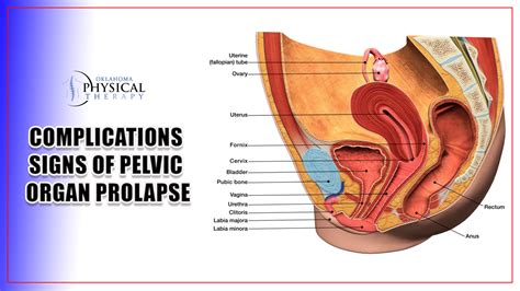 Symptoms and Treatments of Pelvic Organ Prolapse – Comprehensive Guide Plan – Oklahoma Physical ...