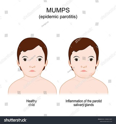 Mumps In Adults