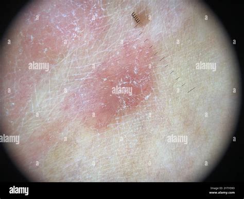 Dermatoscope image of a ringworm infection on a patient's groin. A ringworm (tinea) infection of ...