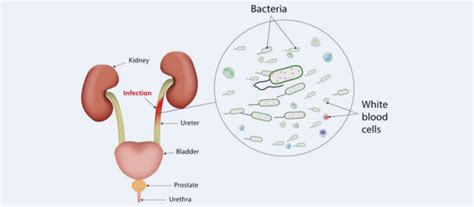 Urinary Tract Infection Treatment Chennai | Anandan's Urology Clinic