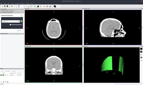 InVesalius Tutorial 的图像结果