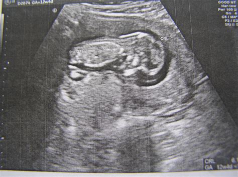 Ultrasound Scans in 9th Week of Pregnancy - ShishuWorld