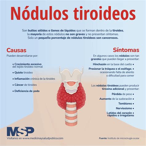 Nodulos En La Tiroides