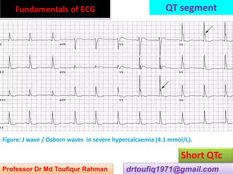 Approach to a patient with QTc interval abnormality in ECG | PPSX
