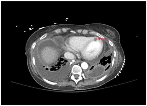 Diagnosis and Treatment of Fungal Infections in Lung Transplant Recipients