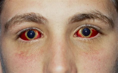 红眼病的症状表现有哪些_红眼病_眼科_99健康网