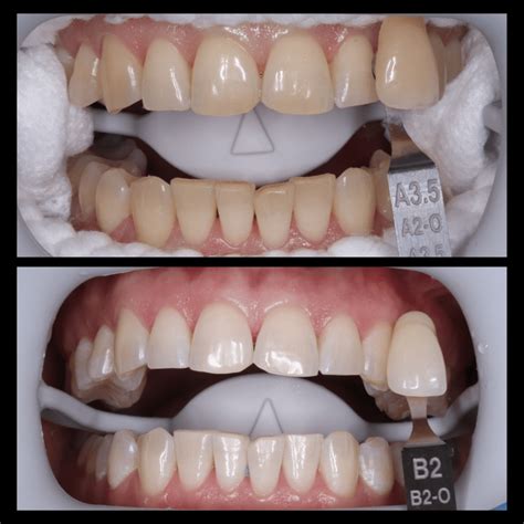We have introduced a new whitening system WHITE smile Flash ...