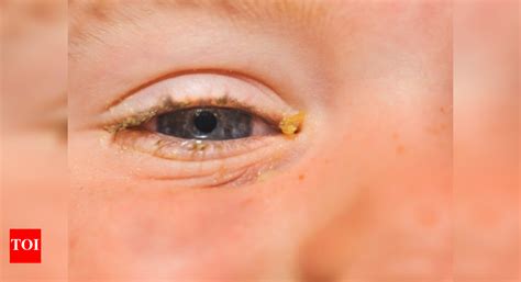 Baby Getting Gunk In Eye at James Marts blog