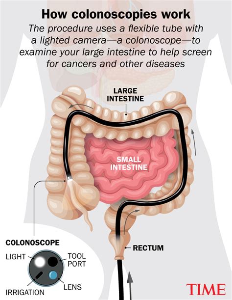 Image result for Why Colonoscopy Test Is Done