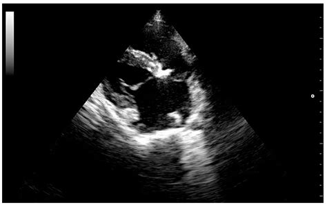 Mitral Kissing Vegetation and Acquired Aortic Valve Stenosis Secondary ...