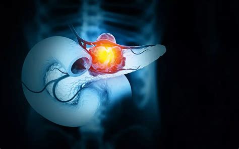 Perioperatives Drug Repurposing beim Pankreaskarzinom