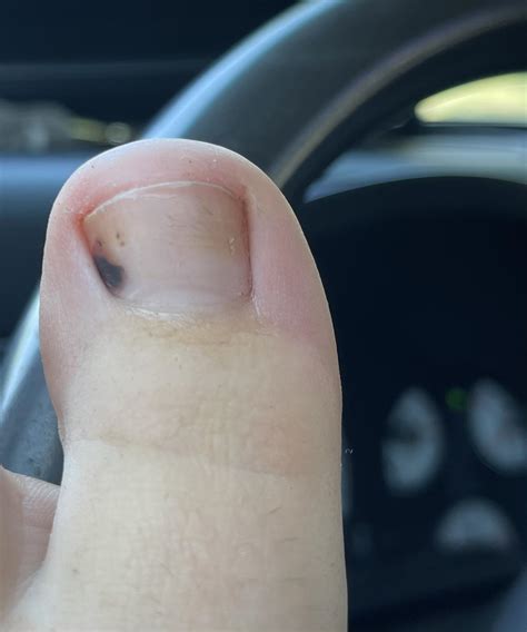 Black spot on toe : r/NailFungus
