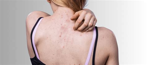 Bacne 101: Acne on Back Reasons and Treatment - The Pink Foundry