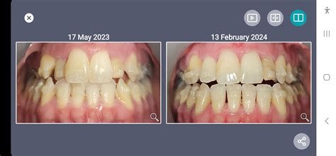 Tray 18 of 20 : r/Invisalign