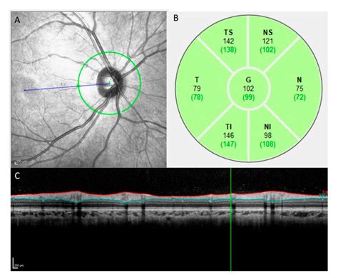Thicker Retinal Nerve Fiber Layer with Age among Schoolchildren: The Hong Kong Children Eye Study - layers of nerve fibre
