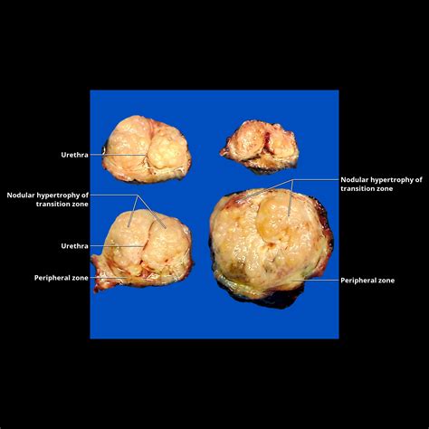 Simple Renal Cyst | Radiology Key