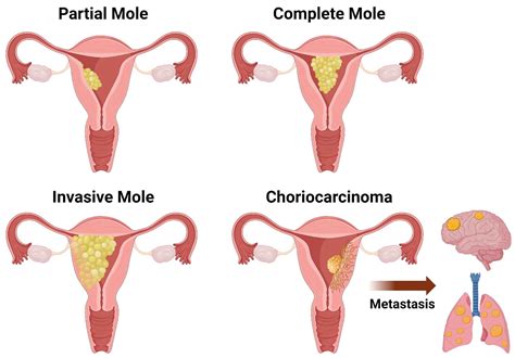 Gestational Trophoblastic Disease: Complete versus Partial Hydatidiform Moles