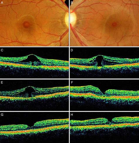 Macular hole causes, symptoms, diagnosis, treatment & prognosis
