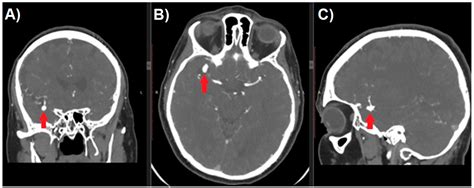 Cerebral Aneurysm Angiogram