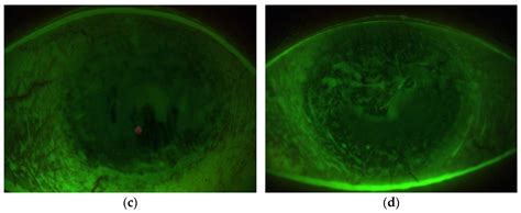 Diagnostic Algorithm for Surgical Management of Limbal Stem Cell Deficiency