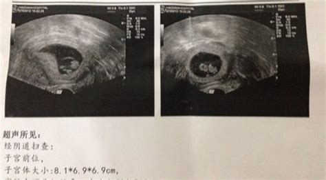 哪位专家能帮我看看这个B超图有可能是双胞胎吗，8周1天 谢谢 - 百度宝宝知道