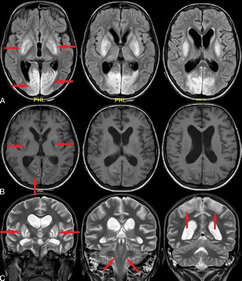 A Case of Multidrug-Resistant Lance-Adams Syndrome Successfu ...