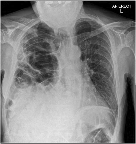 A tale of two unconventional adult diaphragmatic hernias | The Annals ...