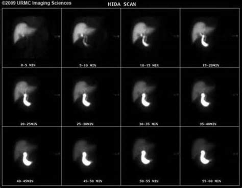 Image result for Hida Scan Explained