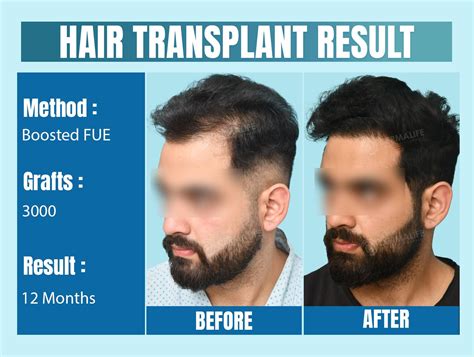 Hair Transplant Before After Result - 3000 Grafts