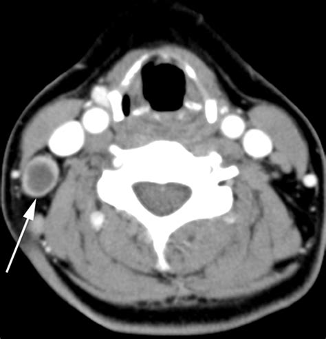 Kikuchi Disease: Differentiation from Tuberculous Lymphadenitis Based ...