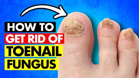 How To Get Rid Of Fungus Toenails Naturally at Elijah Byrnes blog