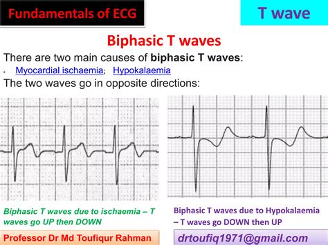 Approach to a patient with T wave abnormality in ECG | PPSX