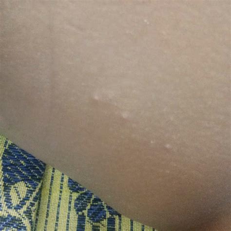 Hey doctors my baby is 5 months old n she got small pimples on stomach n back...it's cold here ...