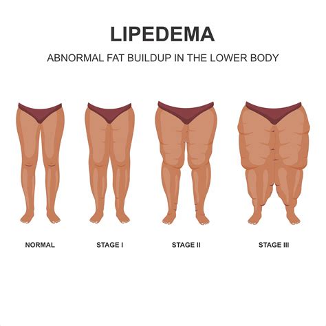 A Guide to Lipedema Treatment: Managing Symptoms & Enhancing Well-being