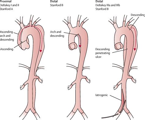 Aortic Dissection