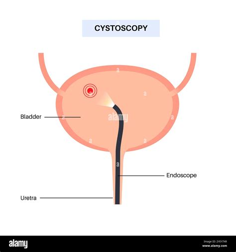 Image result for Cystoscopy Procedure