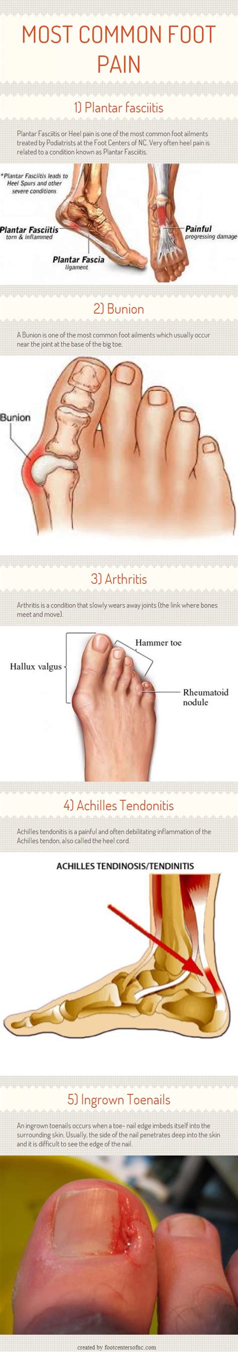 Types Of Foot Pain Diagram at Randy Christofferse blog