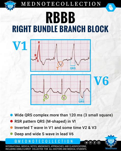 RIGHT BUNDLE BRANCH BLOCK - MEDizzy