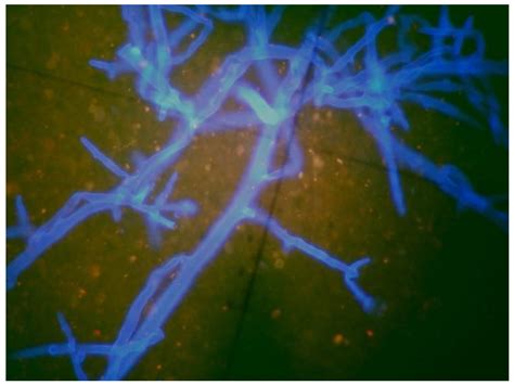 Isolated Cerebral Mucormycosis Caused by Lichtheimia Species in a ...