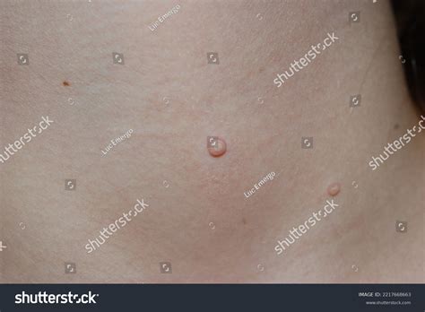 Molluscum Contagiosum Water Wart On Skin Stock Photo 2217668663 ...