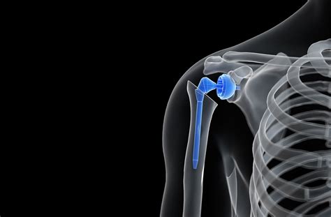 Shoulder Replacement Surgery in Dubai - Best Shoulder Replacement Dubai