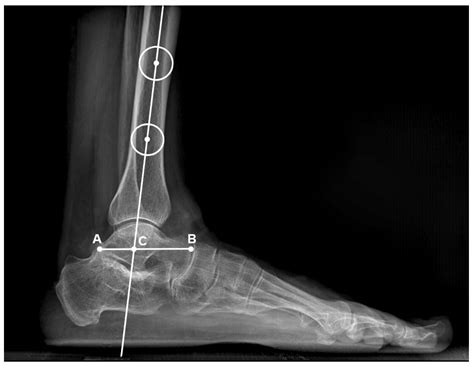 Impact of Subtalar Distraction Arthrodesis on Ankle Joint: Radiological ...
