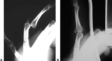 Image result for Finger Dislocation Treatment