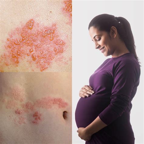 Guidelines on post-exposure prophylaxis (PEP) for varicella or shingles ...