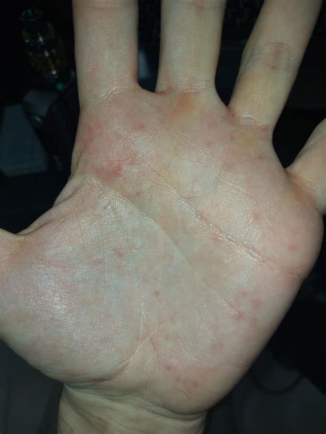 Anyone know what these red spots are? They only ever pop up on my palms ...