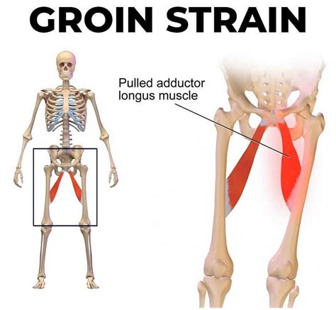 Groin Strain Exercises at Ronda Guzman blog