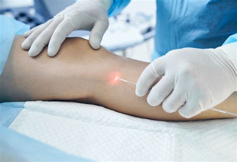 Endovenous ablation - Vein Care | Northwell Health