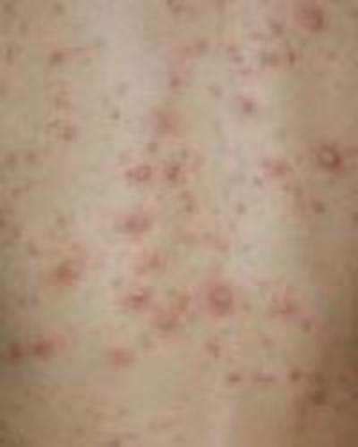 Chicken pox? Your child needs care