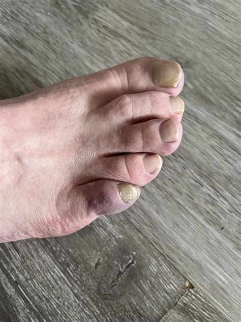 FIL (60m) pinky toes (both feet) look like this. He says they’re very ...
