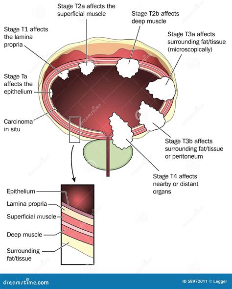 Staging of bladder cancer stock vector. Illustration of cancer - 58972011